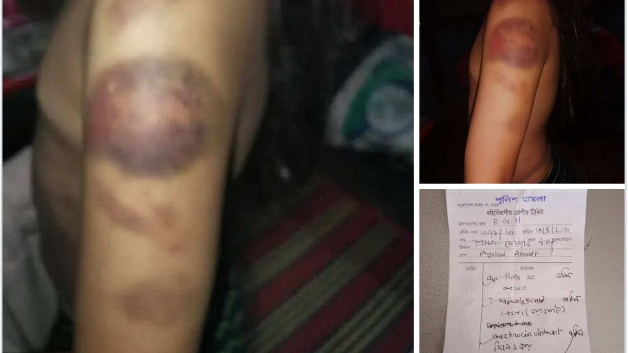 রাঙামাটিতে 'রাখাইন' শিক্ষিকার বেত্রাঘাতে তৃতীয় শ্রেণির 'চাকমা' শিক্ষার্থী আহত